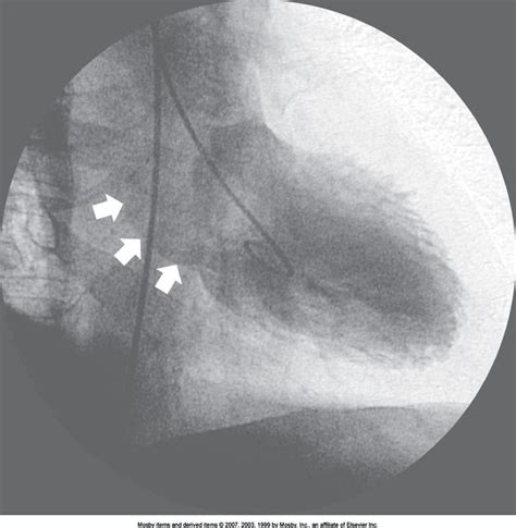 lv gram medical abbreviation|left heart catheterization with lv.